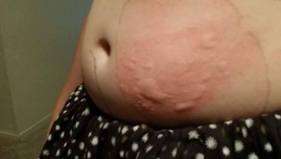 Photo of We&rsquo;ve Tried Everything for My Daughter&rsquo;s Insulin Allergy